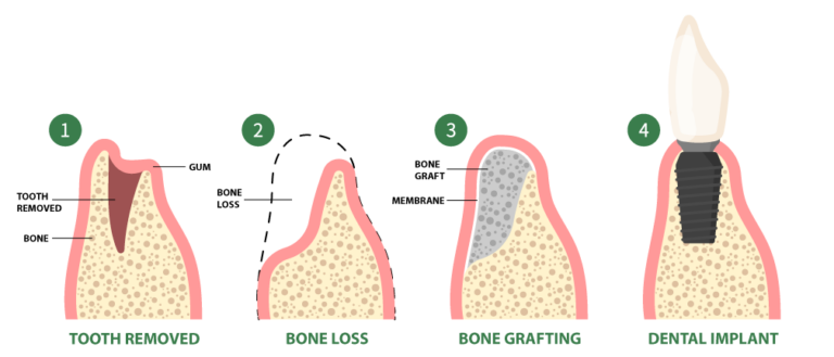 Bone Grafting Procedure | Southlake Oral Surgery