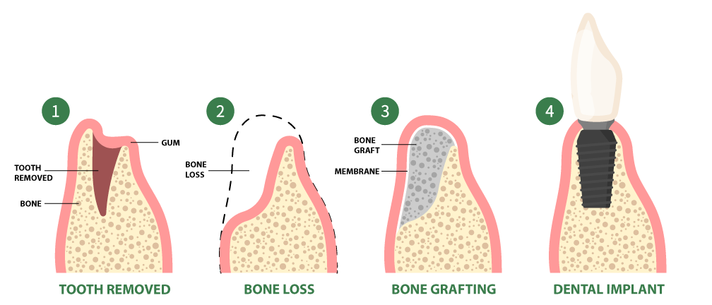 Bone Grafting Procedure
