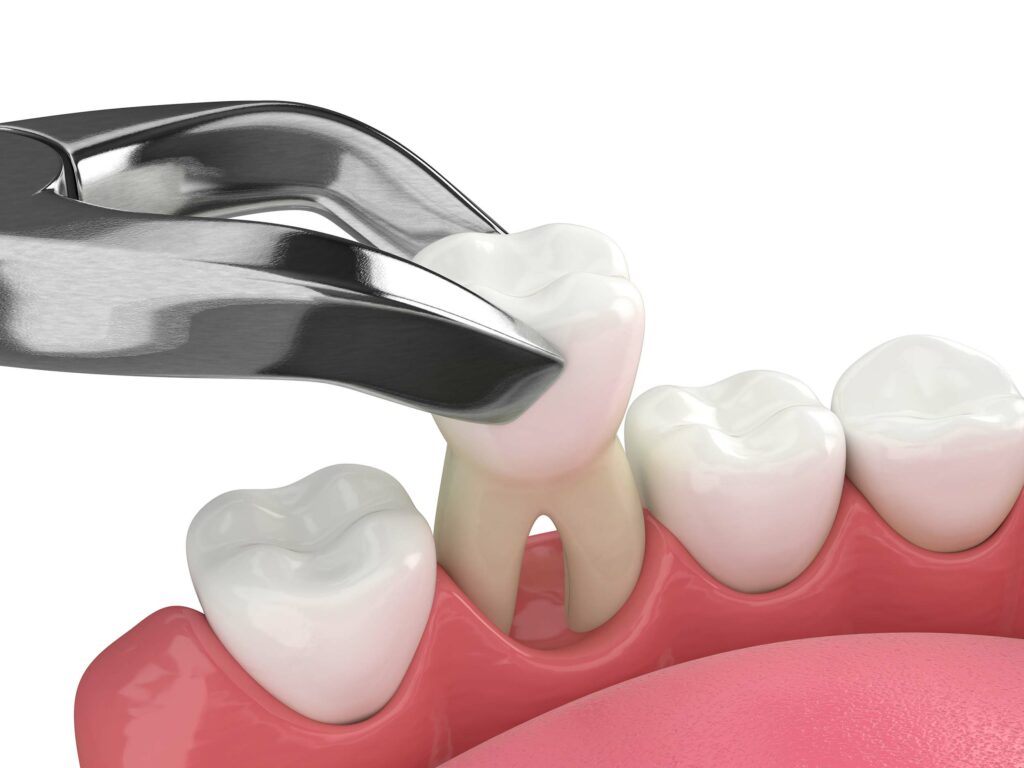 Tooth Extraction in Southlake