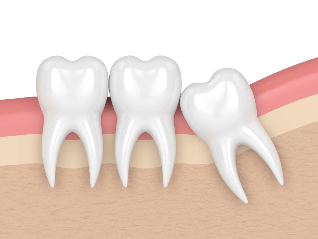 Wisdom Teeth Removal in Southlake